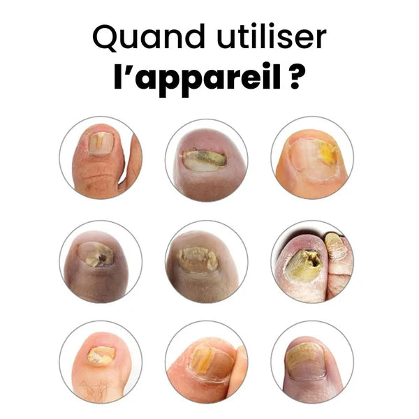 MycoPulse™ - Technologie LED contre la mycose des ongles