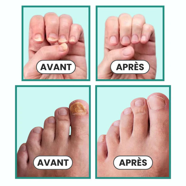 MycoPulse™ - Technologie LED contre la mycose des ongles
